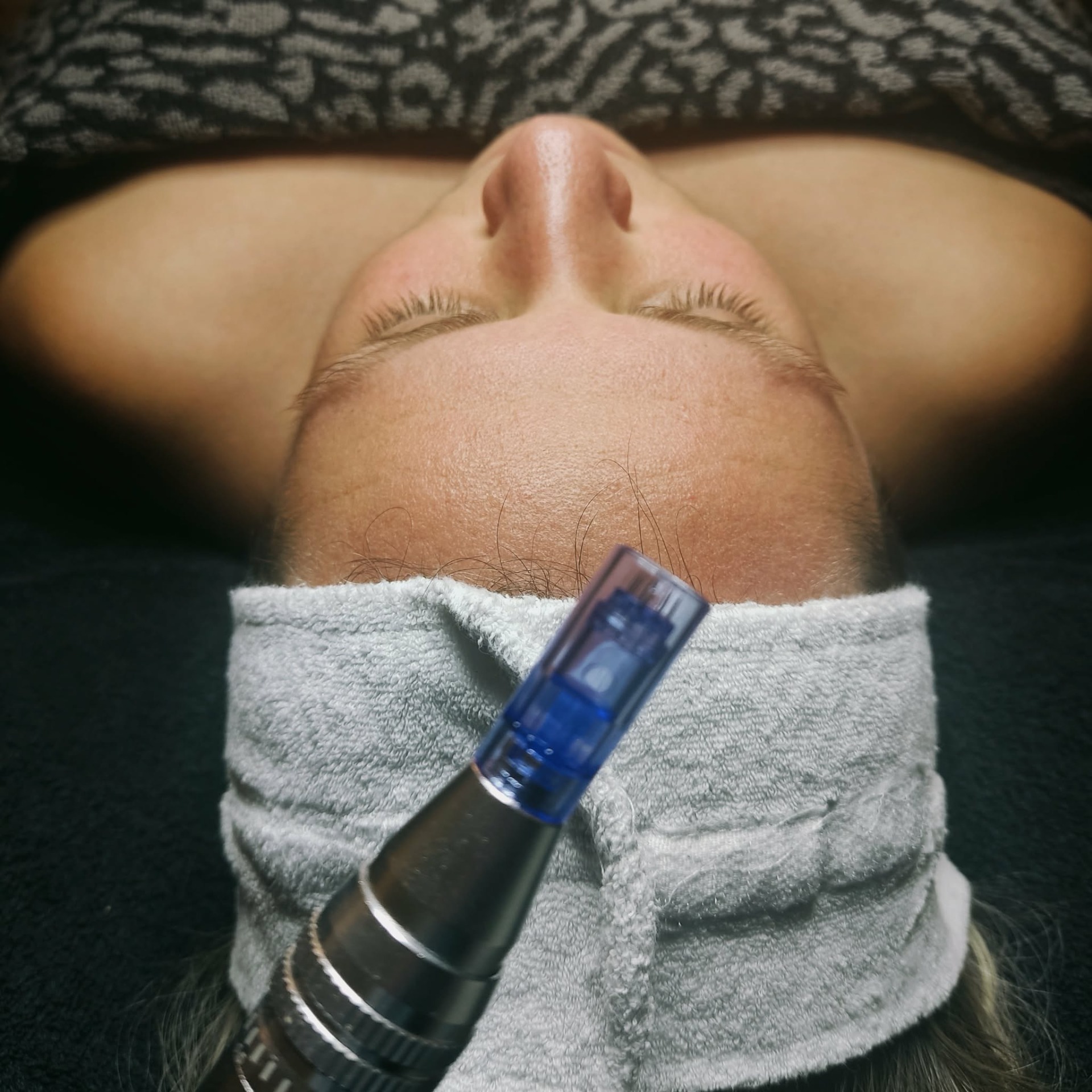 Microneedling